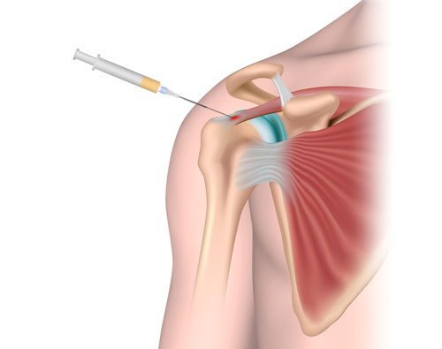 Shoulder Pain Injection